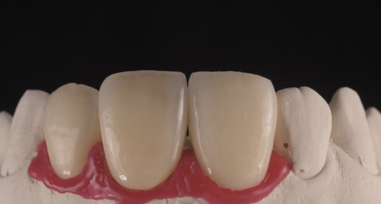 Shade Matching Case 01